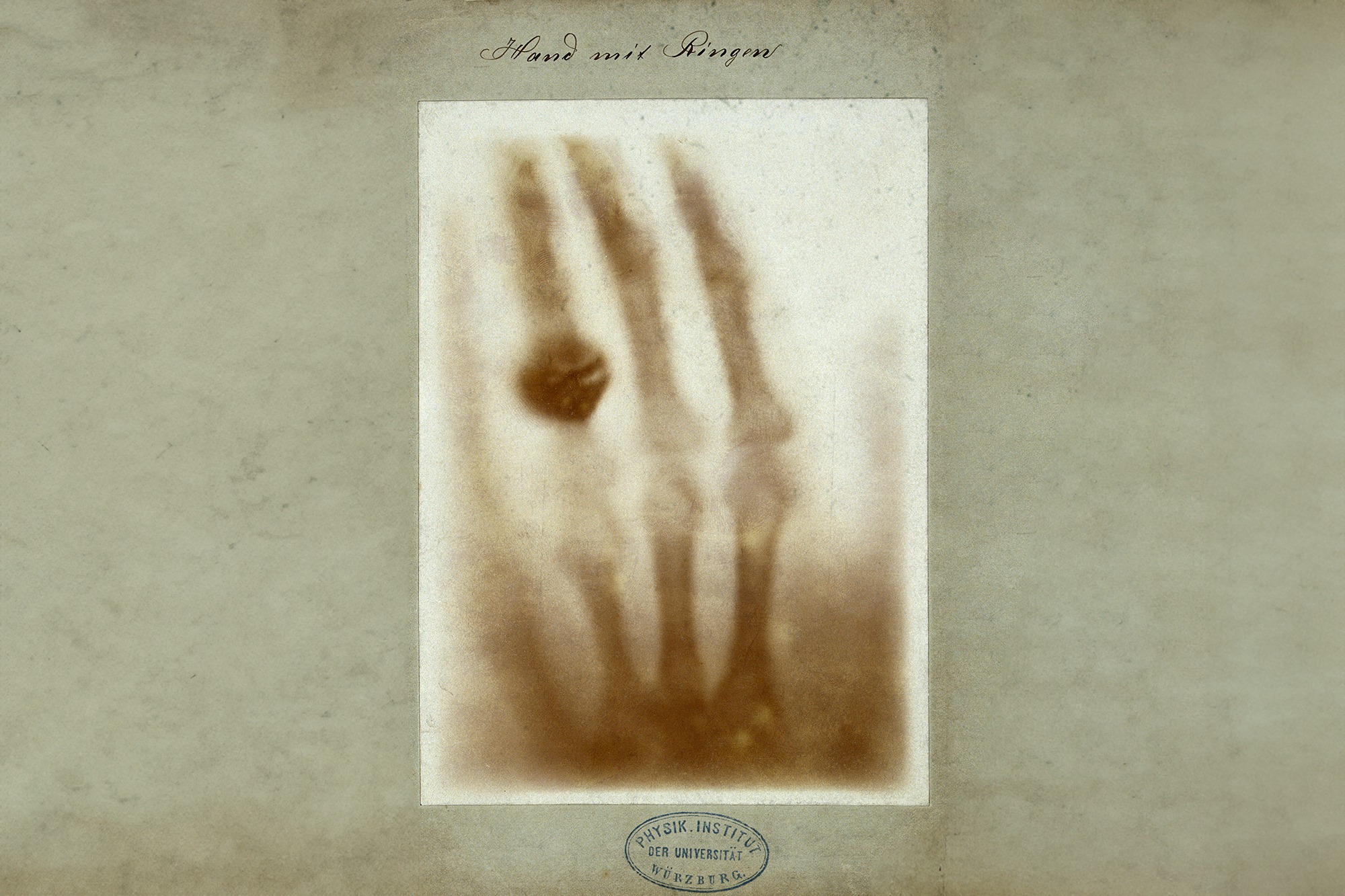 Рука с кольцами. Рентгеновский снимок кисти супруги Вильгельма Рентгена.